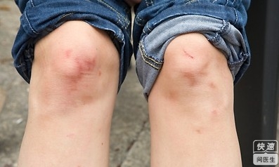 關節炎和(hé)風(fēng)濕的(de)區(qū)别在哪裡(lǐ)